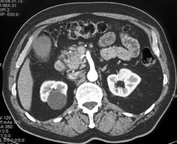 Renal Cyst and Pancreatic Intraductal Papillary Mucinous Neoplasm (IPMN) - CTisus CT Scan