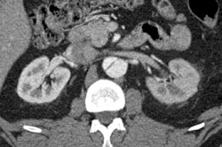 Decreased Left Renal Function Due to Aortic Dissection - CTisus CT Scan