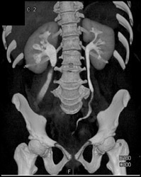 Obstructed Right Ureter - CTisus CT Scan