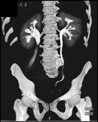 Dilated Right Renal Pelvis on CT Urogram - CTisus CT Scan