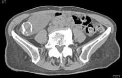 Renal Cell Carcinoma - CTisus CT Scan