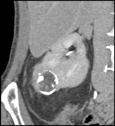 Renal Cell Carcinoma - CTisus CT Scan