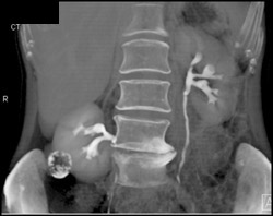 Renal Cell Carcinoma - CTisus CT Scan