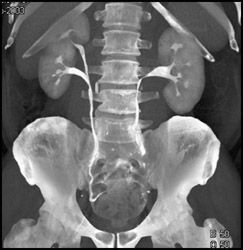 Duplicated Renal Pelvis - CTisus CT Scan