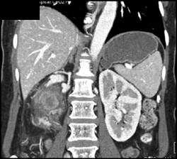 Renal Laceration - CTisus CT Scan