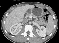 Renal Cell Carcininoma (rt Kidney) - CTisus CT Scan