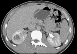 Renal Cell Carcinoma - CTisus CT Scan