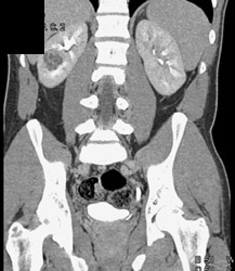 Cystic Renal Cell Carcinoma - CTisus CT Scan