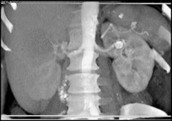 Renal Artery Aneurysm - CTisus CT Scan