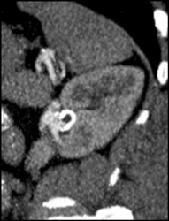 Left Renal Artery Aneurysm - CTisus CT Scan