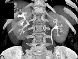 Renal Artery Aneurysm - CTisus CT Scan