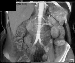 Retroaortic Left Renal Vein - CTisus CT Scan