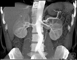 Ct Angiogram With Normal Renal Arteries - CTisus CT Scan