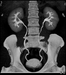 Normal CT Urogram - Kidney Case Studies - CTisus CT Scanning