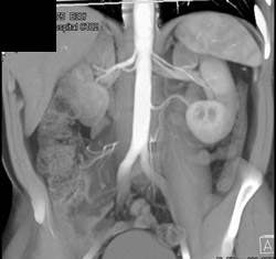 3 Left and 2 Right Renal Arteries in A Renal Donor - CTisus CT Scan