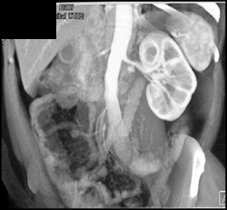 Circumaortic Renal Vein - CTisus CT Scan