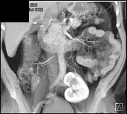 Pelvic Kidney - CTisus CT Scan