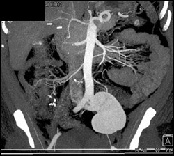 Multiple Renal Arteries - CTisus CT Scan