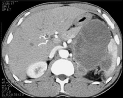 Large Necrotic Renal Cell Carcinoma Invades Spleen - CTisus CT Scan