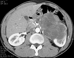 Necrotic Renal Cell Carcinoma - CTisus CT Scan