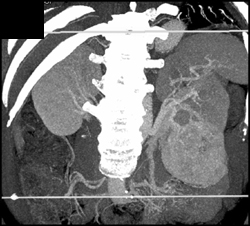 Renal Cell Carcinoma - CTisus CT Scan