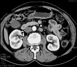 Subtle Left Renal Cell Carcinoma (look at Next Set of Images Also) - CTisus CT Scan