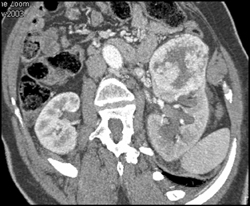 Renal Cell Carcinoma - CTisus CT Scan