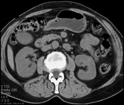 Hypervascular Renal Cell Carcinoma in Left Kidney (at 3 O'clock) - CTisus CT Scan