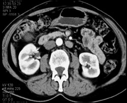 Renal Carcinoma-easy to Miss on Early Phase Image - CTisus CT Scan