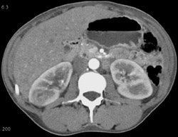 Renal Abscess - CTisus CT Scan