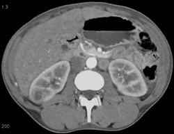 Renal Abscess (right) - CTisus CT Scan