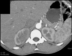 Acute Right Renal Pyelonephritis - CTisus CT Scan