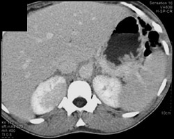 Acute Pyelonephritis - CTisus CT Scan