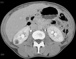 Focal Renal Abscess - CTisus CT Scan