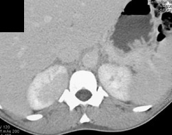 Acute Pyelonephritis - CTisus CT Scan