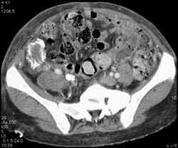 Failed Renal Tx in Right Lower Quadrant - CTisus CT Scan