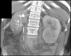 Renal Cell Carcinoma - CTisus CT Scan