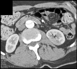 Aortic Dissection With Decreased Flow of Left Kidney - CTisus CT Scan