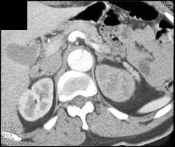 Decreased Flow to Left Kidney With Dissection - CTisus CT Scan