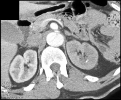 Decreased Function on Left Due to Aortic Dissection - CTisus CT Scan