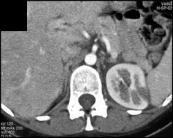 Focal Pyelonephtitis - CTisus CT Scan