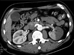 Renal Infarct - CTisus CT Scan