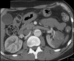 Renal Infarct With Aortic Dissection - CTisus CT Scan