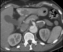 Renal Infarction Eith Aortic Dissection - CTisus CT Scan