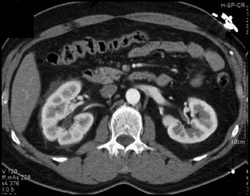 Stranding Around Right Kidney Due to Obstruction - CTisus CT Scan