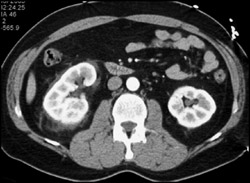 Stranding Near Left Kidney - CTisus CT Scan