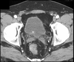 Stone Passed Into Bladder - CTisus CT Scan