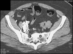 Ct Post Lymphangiogram - CTisus CT Scan