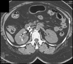 Fistulae From Lymph Drainage to Right Kidney - CTisus CT Scan