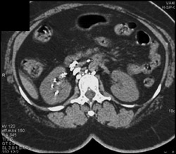 Fistulae to Right Renal Pelvis From Lymphatics - CTisus CT Scan